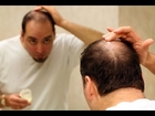 ✤✤✤Hair Regrowth Products For Men, Stem Cell Hair Regrowth, Best Hair Regrowth Method