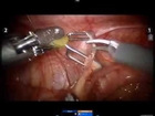 UPJ Obstruction and Kidney Stone Removal.  All Rights Reserved by the Urology Group 2013.