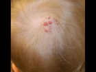 Red Bumps On Scalp, Small Itchy Bumps On Scalp, Painful Itchy Bumps On Scalp, Dry Scalp Bumps