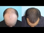 Hair loss before after        arganlife